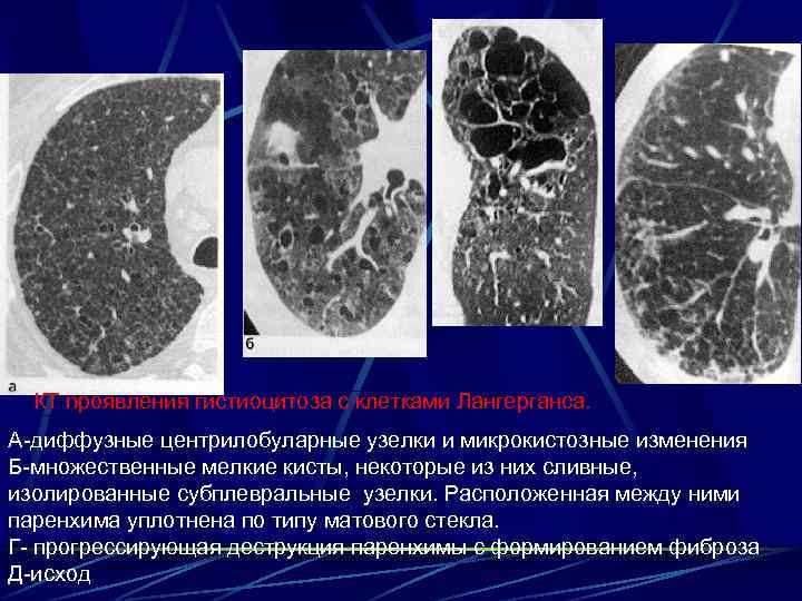 КТ проявления гистиоцитоза с клетками Лангерганса. А-диффузные центрилобуларные узелки и микрокистозные изменения Б-множественные мелкие