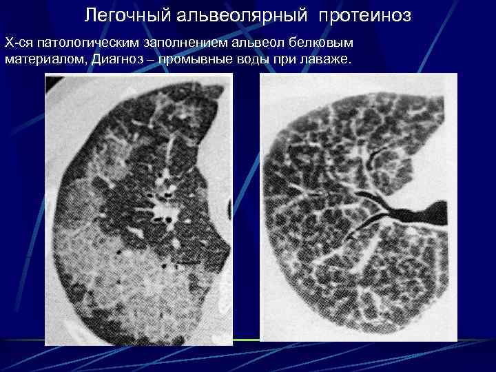 Легочный альвеолярный протеиноз Х-ся патологическим заполнением альвеол белковым материалом, Диагноз – промывные воды при