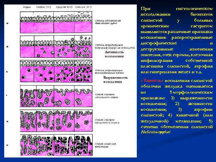 Активность воспаления Выраженность воспаления При гистологическом исследовании биоптатов слизистой у больных хроническим гастритом выявляются