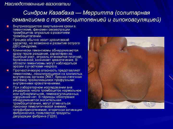 Наследственные вазопатии Синдром Казабаха — Мерритта (солитарная гемангиома с тромбоцитопенией и гипокоагуляцией) Внутрисосудистое свертывание