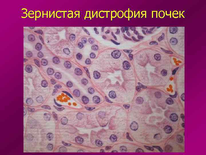 Зернистая дистрофия почек 