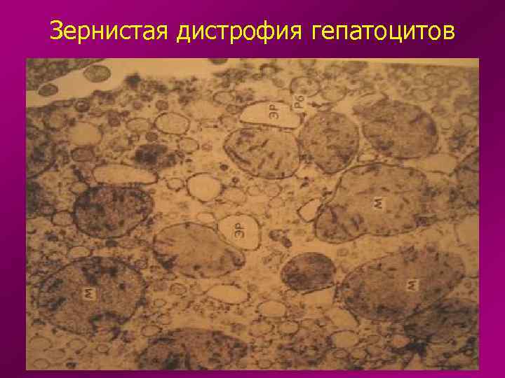 Зернистая дистрофия гепатоцитов 