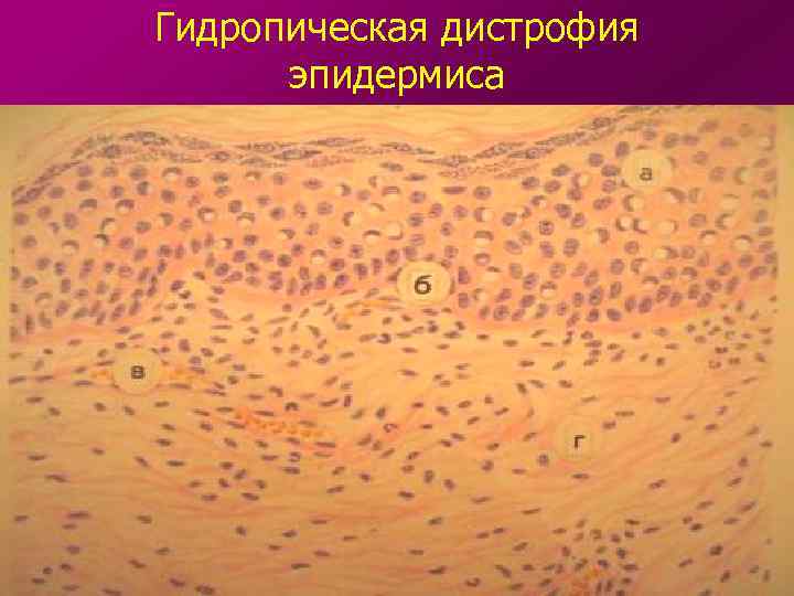 Гидропическая дистрофия эпидермиса 