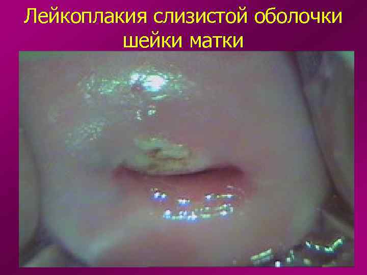 Лейкоплакия слизистой оболочки шейки матки 