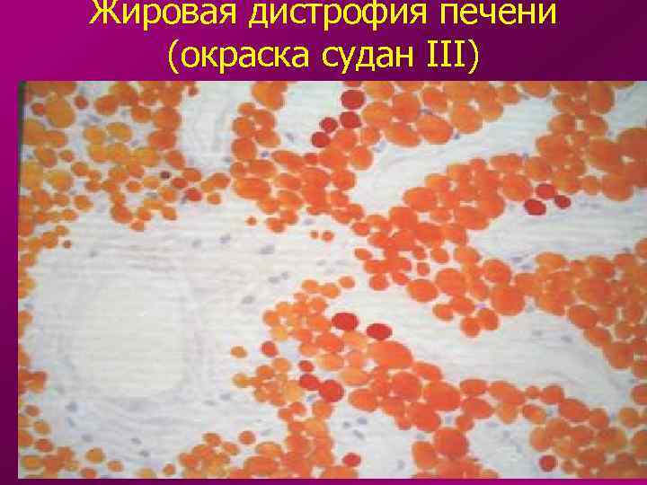 Жировая дистрофия печени (окраска судан III) 