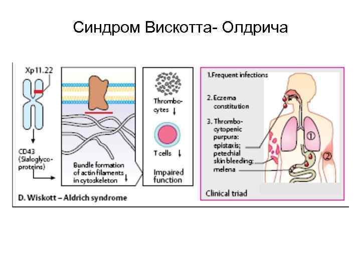 Синдром Вискотта- Олдрича 
