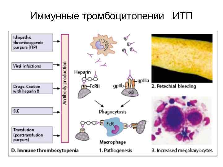 Иммунные тромбоцитопении ИТП 
