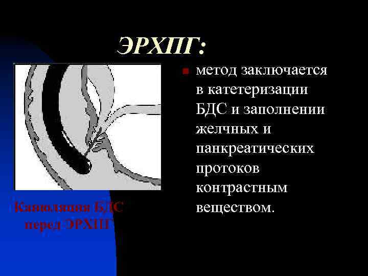 ЭРХПГ: n Канюляция БДС перед ЭРХПГ метод заключается в катетеризации БДС и заполнении желчных