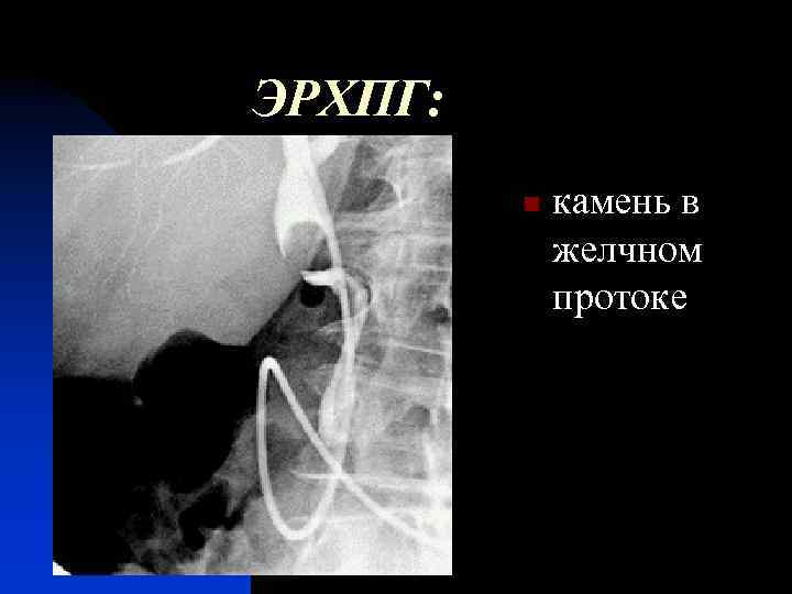 ЭРХПГ: n камень в желчном протоке 