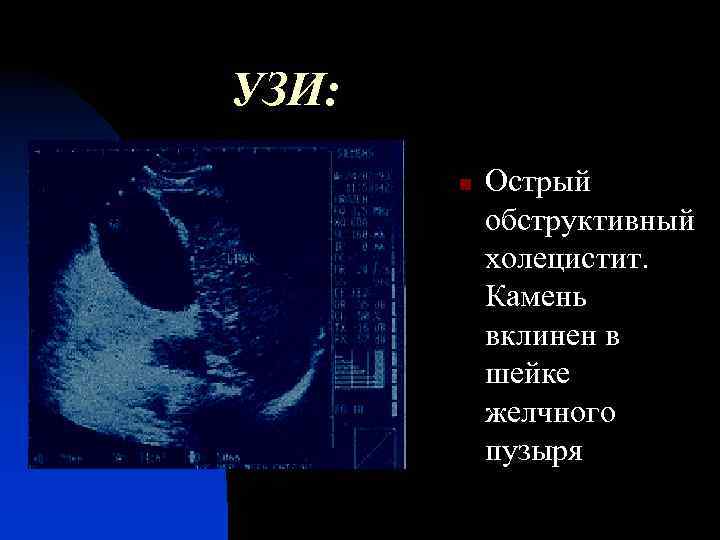 УЗИ: n Острый обструктивный холецистит. Камень вклинен в шейке желчного пузыря 