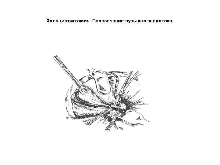 Холецистэктомия. Пересечение пузырного протока. 