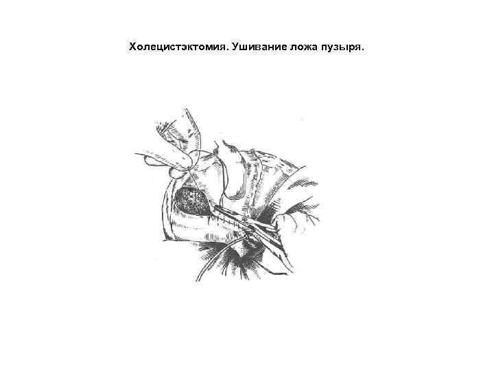 Холецистэктомия. Ушивание ложа пузыря. 