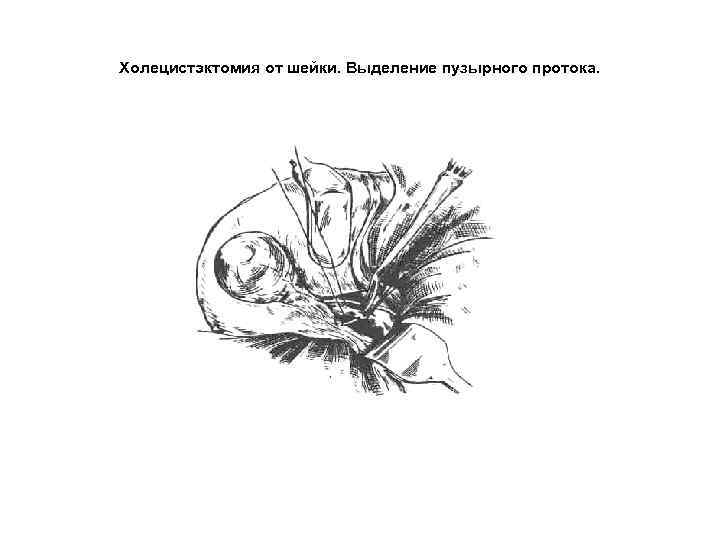 Холецистэктомия от шейки. Выделение пузырного протока. 