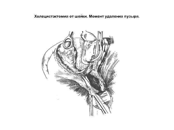 Холецистэктомия от шейки. Момент удаления пузыря. 