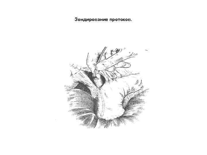 Зондирование протоков. 