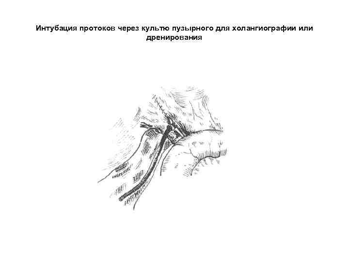 Интубация протоков через культю пузырного для холангиографии или дренирования 