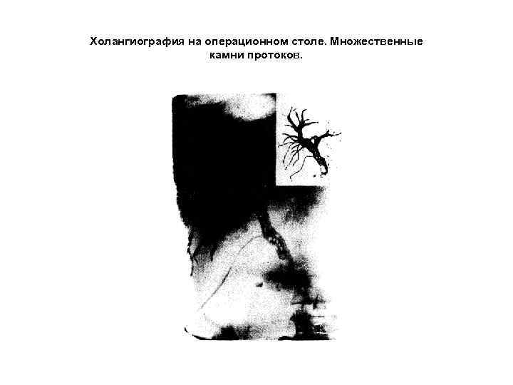 Холангиография на операционном столе. Множественные камни протоков. 