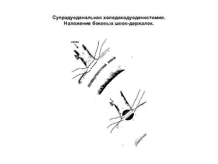 Супрадуоденальная холедоходуоденостомия. Наложение боковых швов-держалок. 