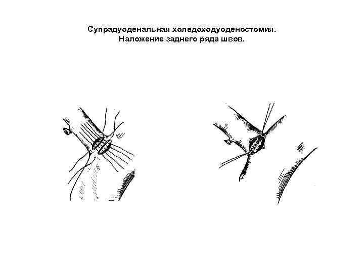Супрадуоденальная холедоходуоденостомия. Наложение заднего ряда швов. 