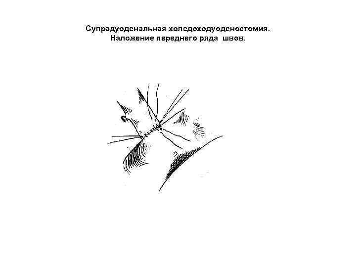 Супрадуоденальная холедоходуоденостомия. Наложение переднего ряда швов. 