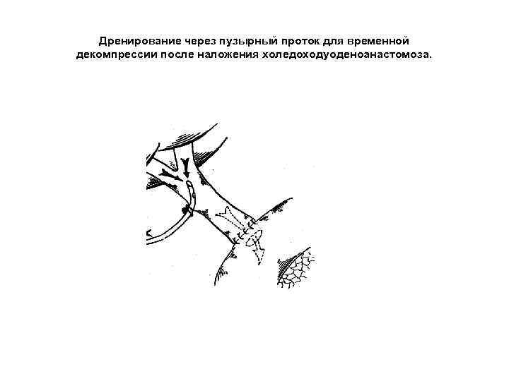 Дренирование через пузырный проток для временной декомпрессии после наложения холедоходуоденоанастомоза. 