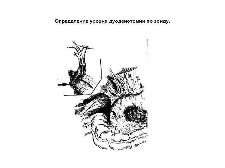 Определение уровня дуоденотомии по зонду. 