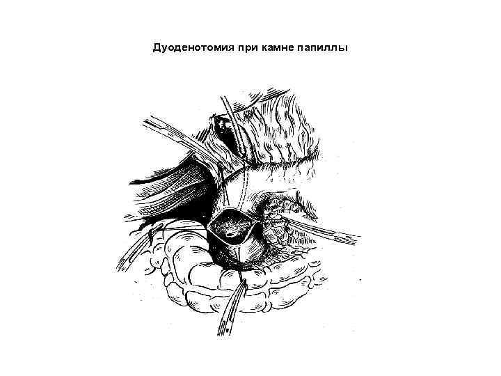 Дуоденотомия при камне папиллы 