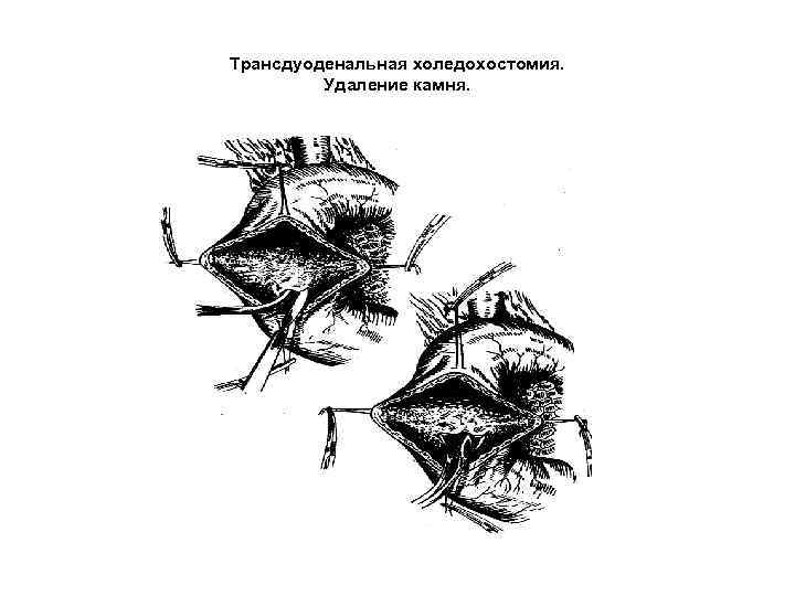 Трансдуоденальная холедохостомия. Удаление камня. 