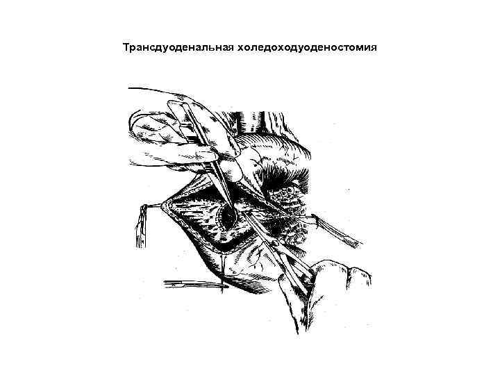 Трансдуоденальная холедоходуоденостомия 