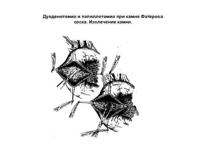 Дуоденотомия и папиллотомия при камне Фатерова соска. Извлечение камня. 
