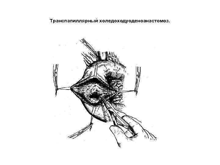 Транспапиллярный холедоходуоденоанастомоз. 