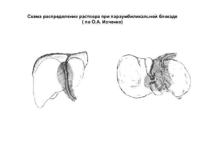 Схема распределения раствора при параумбиликальной блокаде ( по О. А. Ивченко) 