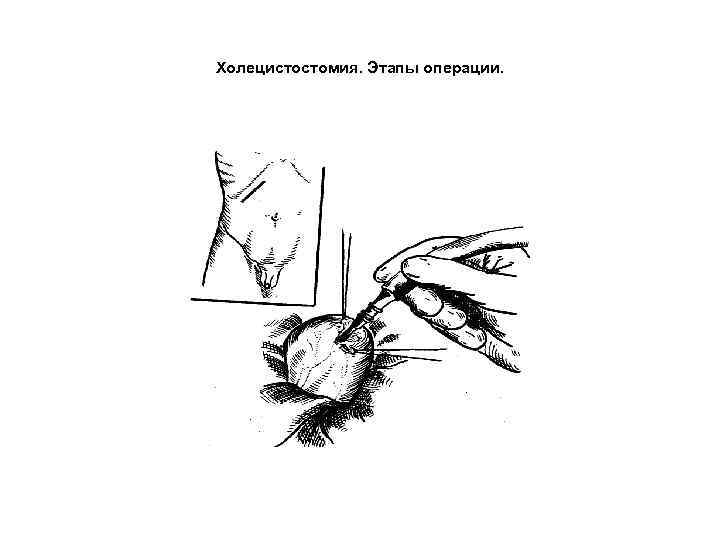 Холецистостомия. Этапы операции. 