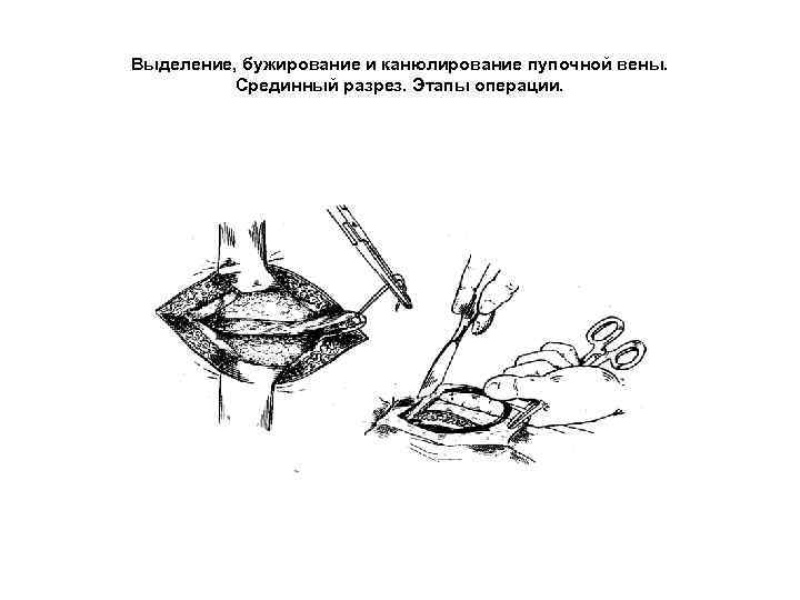 Выделение, бужирование и канюлирование пупочной вены. Срединный разрез. Этапы операции. 