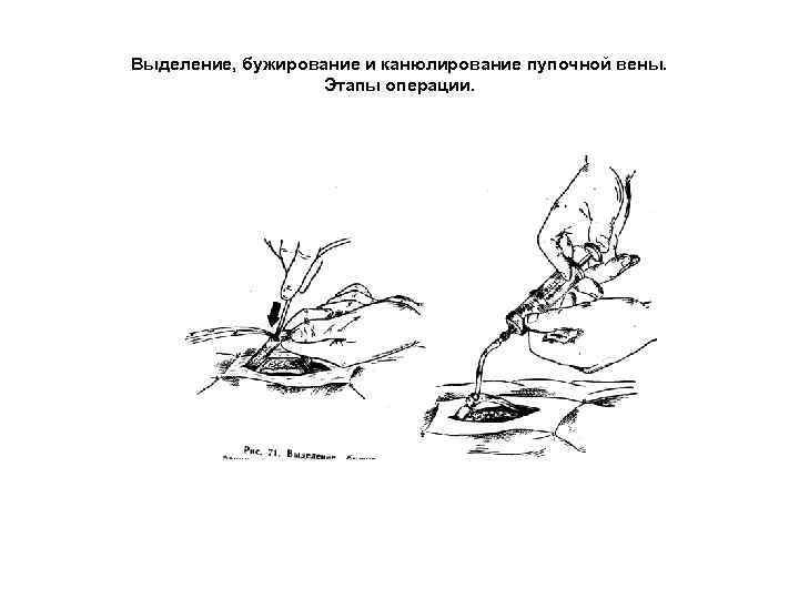 Выделение, бужирование и канюлирование пупочной вены. Этапы операции. 