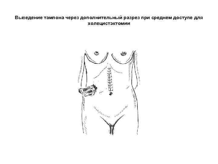 Выведение тампона через дополнительный разрез при среднем доступе для холецистэктомии 