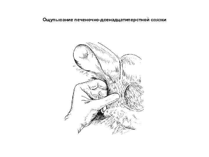 Ощупывание печеночно-двенадцатиперстной связки 