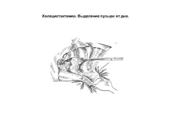 Холецистэктомия. Выделение пузыря от дна. 