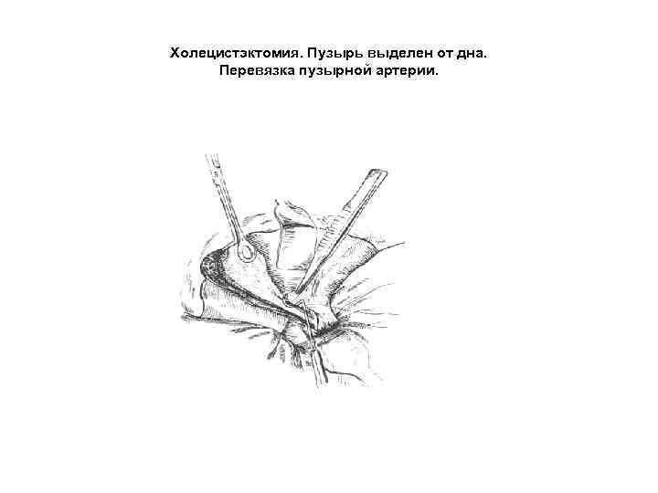 Холецистэктомия. Пузырь выделен от дна. Перевязка пузырной артерии. 