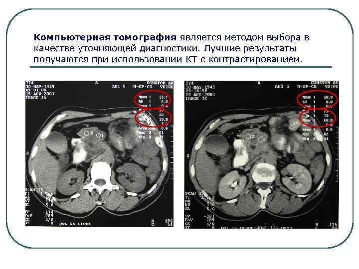 Компьютерная томография является методом выбора в качестве уточняющей диагностики. Лучшие результаты получаются при использовании