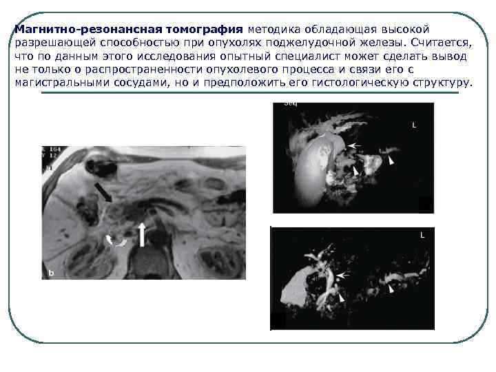 Магнитно-резонансная томография методика обладающая высокой разрешающей способностью при опухолях поджелудочной железы. Считается, что по