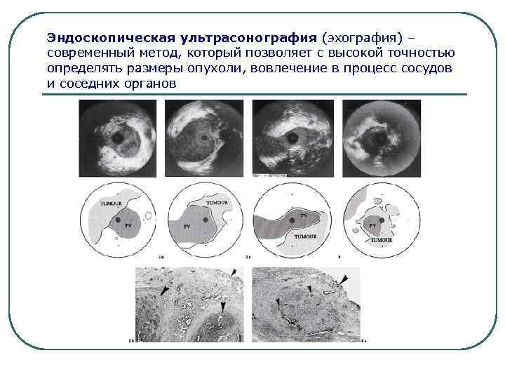 Эндоскопическая ультрасонография (эхография) – современный метод, который позволяет с высокой точностью определять размеры опухоли,