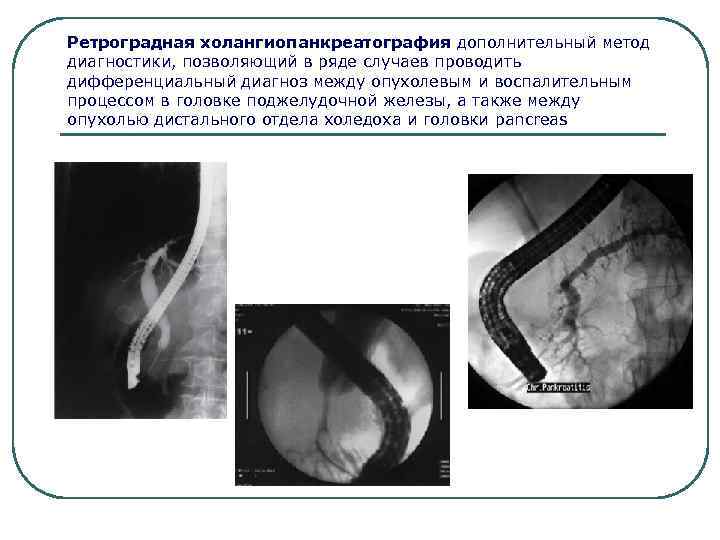 Ретроградная холангиопанкреатография дополнительный метод диагностики, позволяющий в ряде случаев проводить дифференциальный диагноз между опухолевым