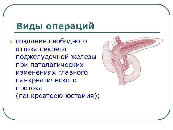 Виды операций l создание свободного оттока секрета поджелудочной железы при патологических изменениях главного панкреатического