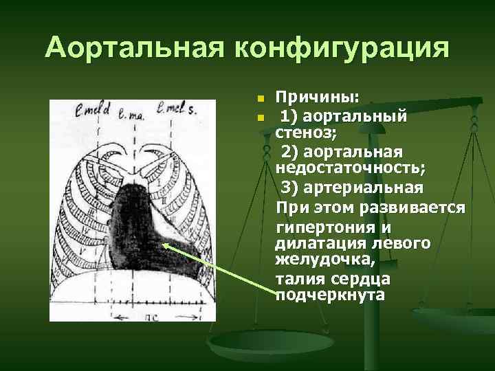 Аортальная конфигурация сердца