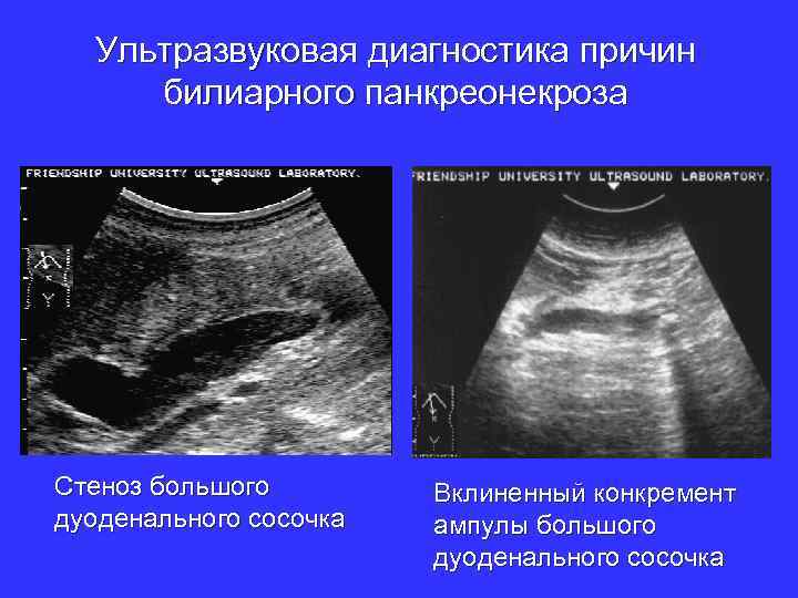 Ультразвуковая диагностика причин билиарного панкреонекроза Стеноз большого дуоденального сосочка Вклиненный конкремент ампулы большого дуоденального