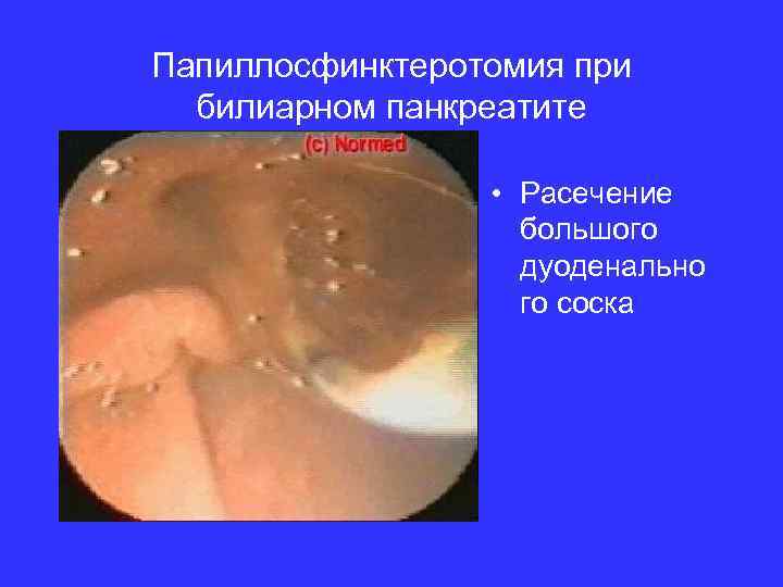 Папиллосфинктеротомия при билиарном панкреатите • Расечение большого дуоденально го соска 