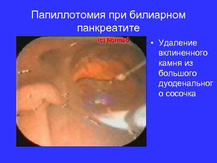Папиллотомия при билиарном панкреатите • Удаление вклиненного камня из большого дуоденальног о сосочка 
