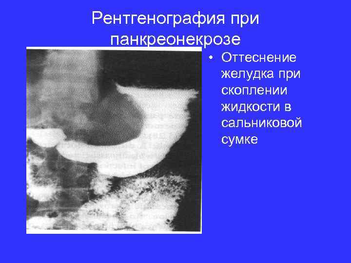 Рентгенография при панкреонекрозе • Оттеснение желудка при скоплении жидкости в сальниковой сумке 