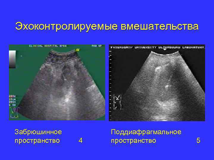 Эхоконтролируемые вмешательства Забрюшинное пространство 4 Поддиафрагмальное пространство 5 